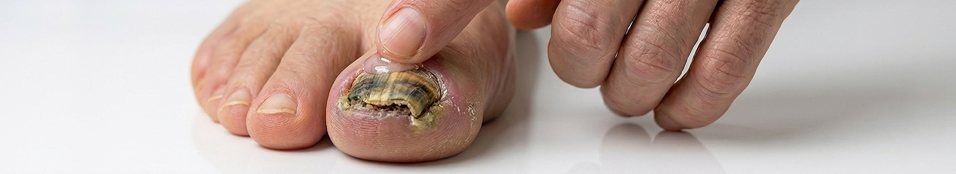 Nail Fungus Treatments