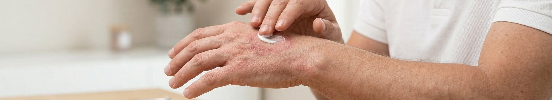 Tinea & Ringworm Treatments